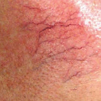 Telangiectasia / Spider Veins