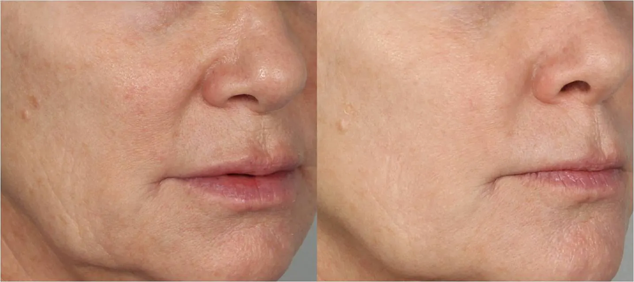 Morpheus8 before and after