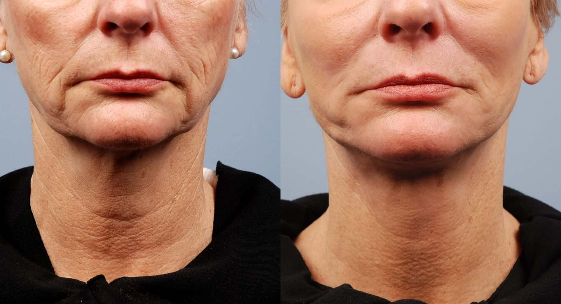 Morpheus8 before and after