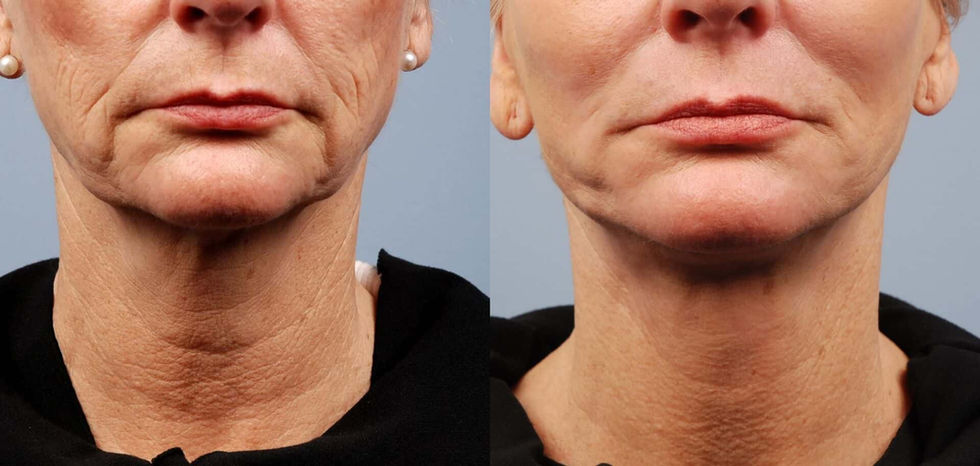 Morpheus8 before and after face
