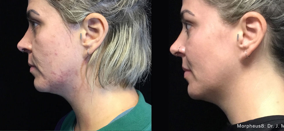 Morpheus8 Before and After Blissfusion Belton Texas