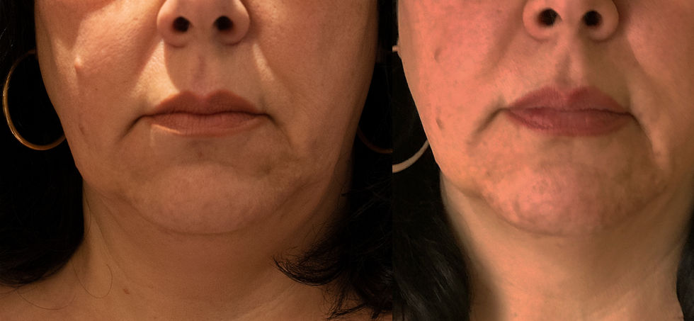 Morpheus8 Before and After Blissfusion Belton Texas