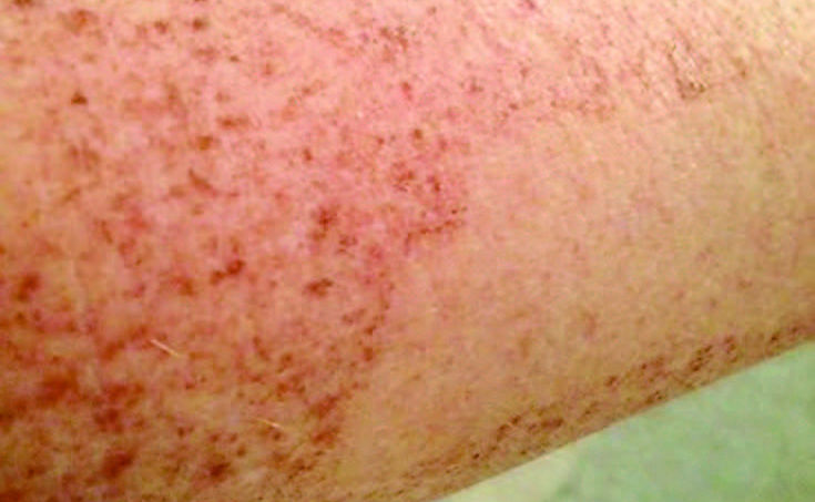 Lumecca IPL treatment before and after Blissfusion Belton, Texas