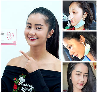 เสริมจมูก บวม