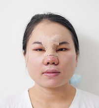เสริมจมูก บวม