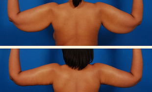 arm lift