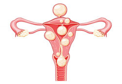 Miomas