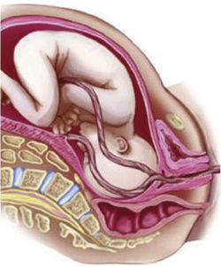 prolapso Cordón umbilical