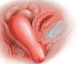 Prolapso Uterino o Vaginal