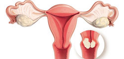 Tumores Pelvicos