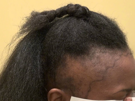 The sensitive issue of traction alopecia in African women