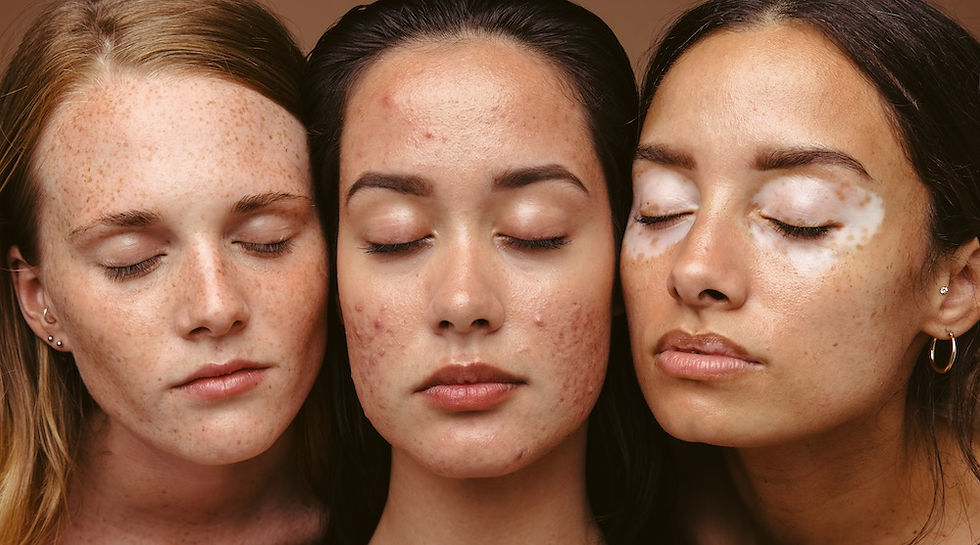 essential oils acne skin, essential oil oily skin