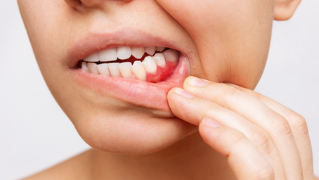 No More Receding Gums: Essential Oils for Gums That Heal Mouth Ulcers