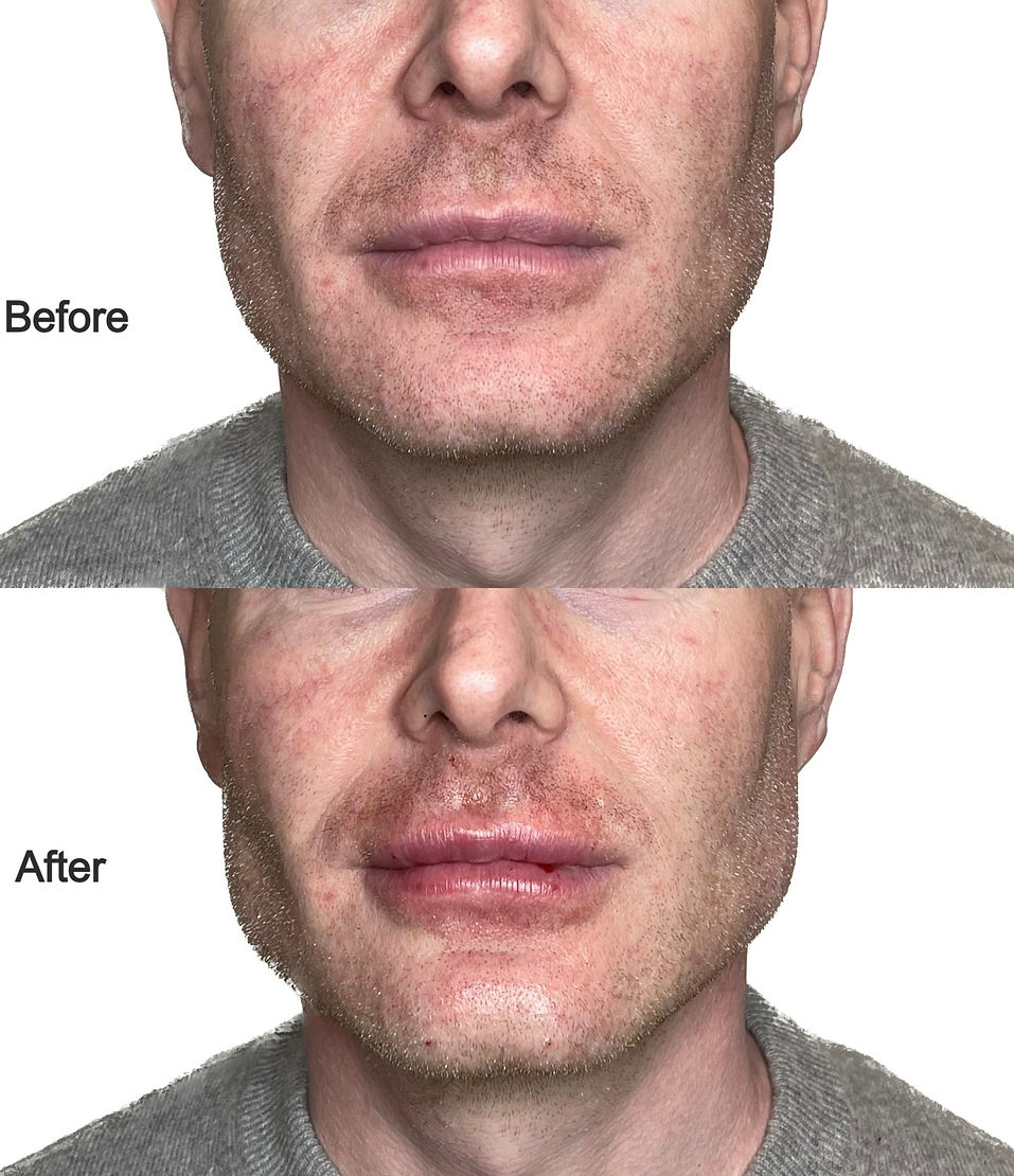 Jawline filler Kallistos house Wellingborough