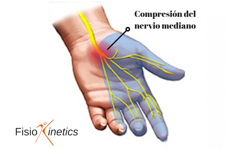 Compresion del nervio med.png