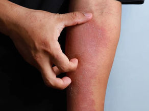 A hand scratches a red, irritated forearm with dry skin against a plain background, indicating discomfort or itching.