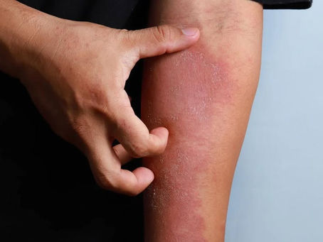 A hand scratches a red, irritated forearm with dry skin against a plain background, indicating discomfort or itching.