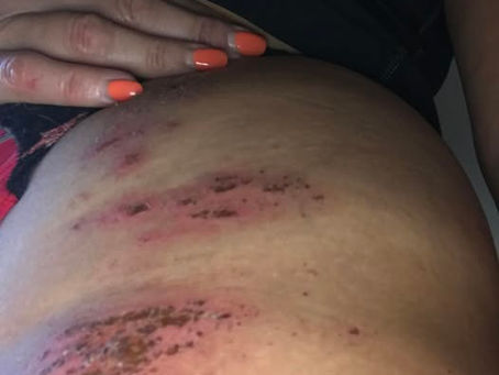 Close-up of a hand with orange nails touching an injured, bruised abdomen, showing red abrasions. The mood appears concerned.