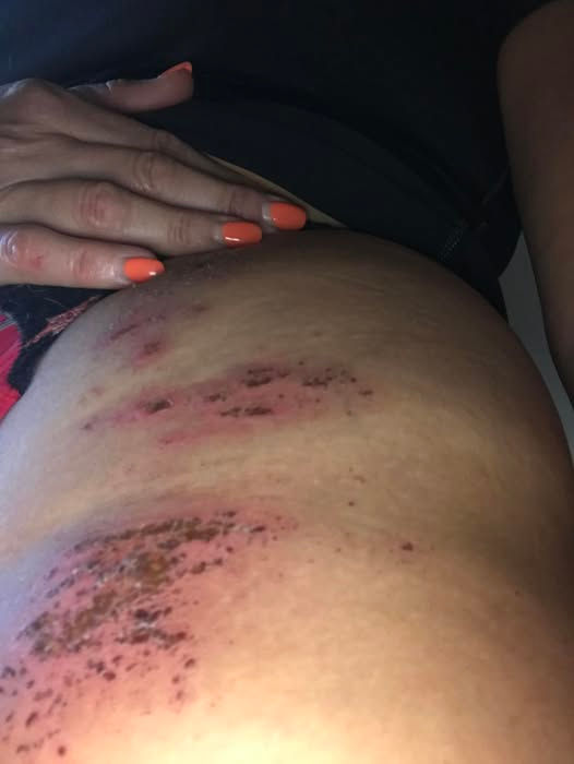 Close-up of a hand with orange nails touching an injured, bruised abdomen, showing red abrasions. The mood appears concerned.