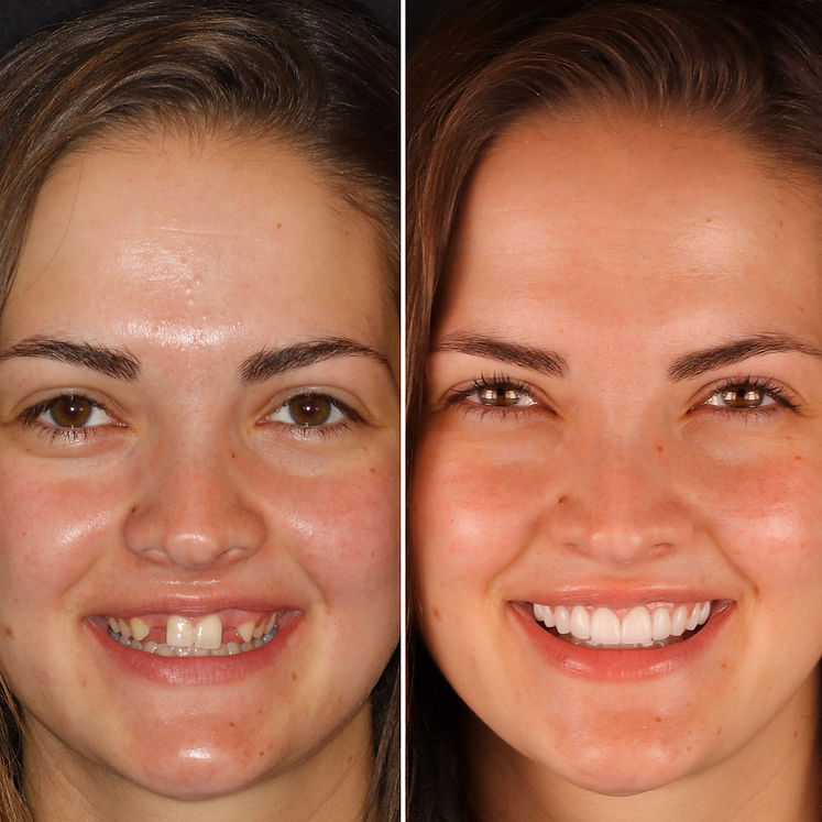 Cosmetic Porcelain Veneers and Dental Implants