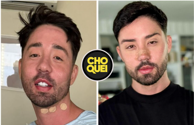 Rico mostrou em primeira mão para Domingo Espetacular. O resultado de sua cirurgia plástica facial.
