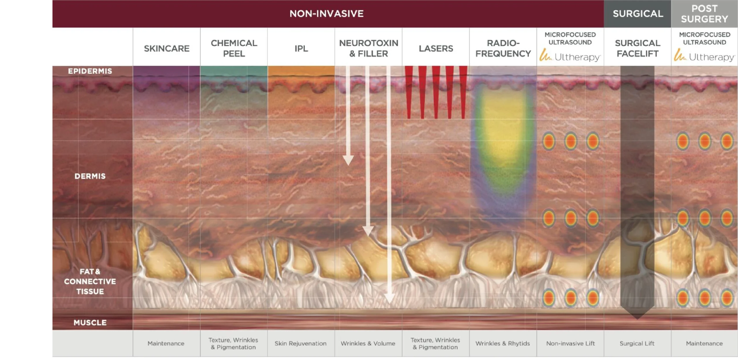 Diagram of depth of Ultherapy penetration