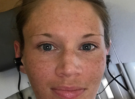 Lift Summer Sun Damage with IPL
