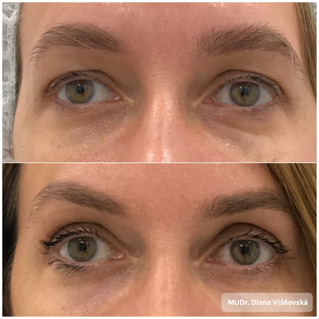 Before and After Ultherapy Brow Lift