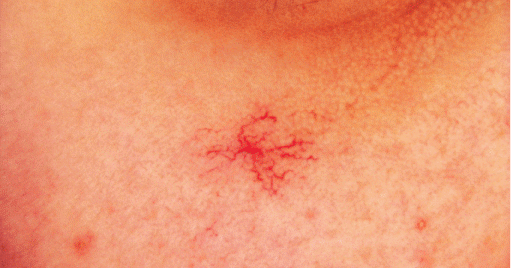 Image Hemangioma