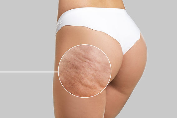 b12 injections for cellulite A Solution for Cellulite is Here!