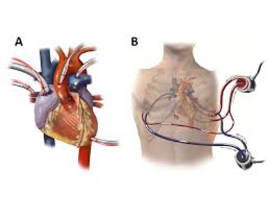 Miniatura: ASISTENCIA VENTRICULAR