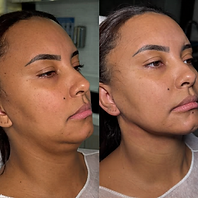Resultado de lipo de papada em Betim/MG