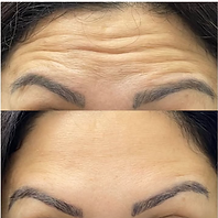 Resultado de aplicação de botox em Betim/MG