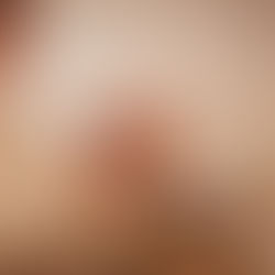 Acupuntura para engravidar: procedimento auxilia no tratamento da infertilidadefeminina e masculina