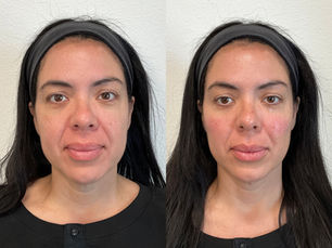 Smile Lines: Why I Don’t Start With Filler Directly in the Lines
