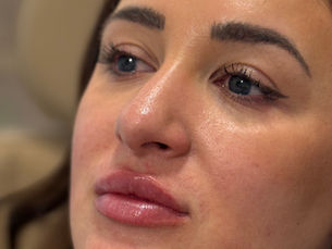 lip filler facial balancing