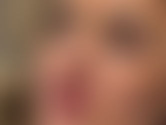 lip filler facial balancing