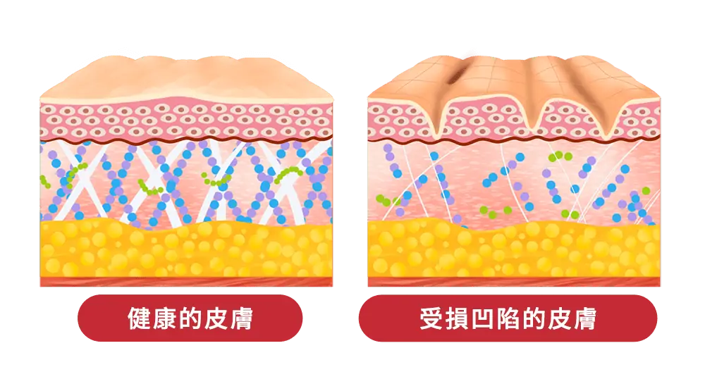 消除凹凸洞示意圖.webp