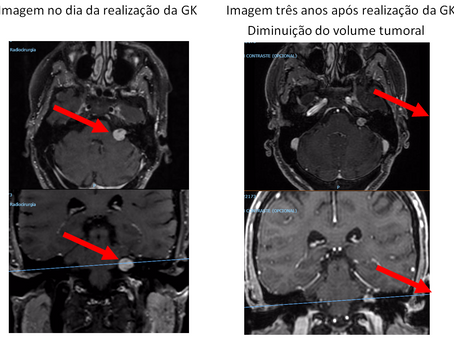 Neurinoma do acústico recidivado