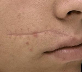 scar.jpeg