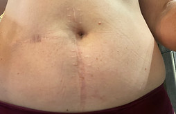 scar healing after red light therapy