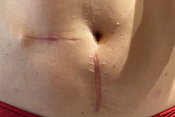 scar healing before red light therapy