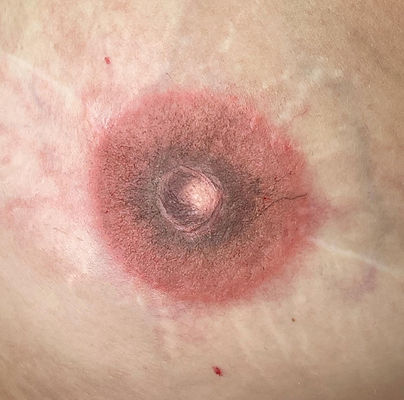 Dermopigmentation d'une aréole mammaire