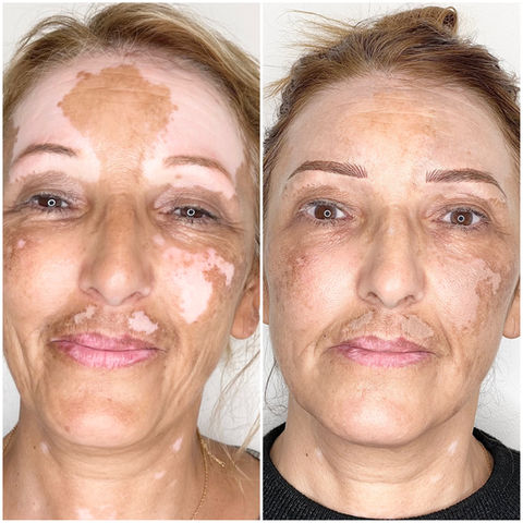 depigmentation de la peau