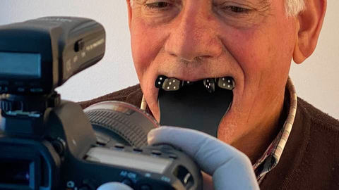 Prótese Híbrida Bimaxilar