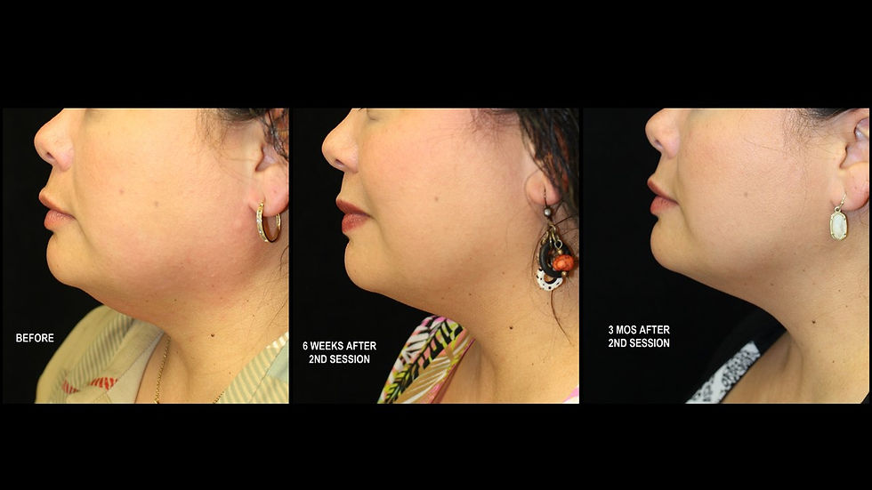 Kybella lower face profile