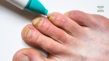 Kalknagels behandelen: oorzaken, herkenning en wat een pedicure voor je kan doen