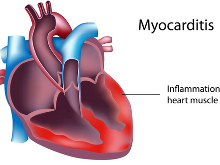 NOTB SPECIAL REPORT ON MYOCARDITIS, PERICARDITIS & DEATH WITHIN SPORTS