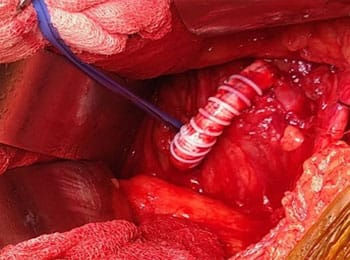 Ring-reinforced graft - curtesy Dr. R. Lahiry
