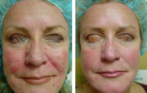 before and after picture of a white women with rosacea